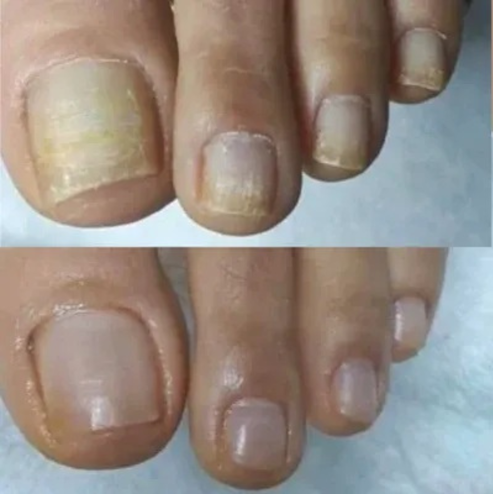 NagelVita Pro – Laser-Nagelpilz-Behandlungsgerät