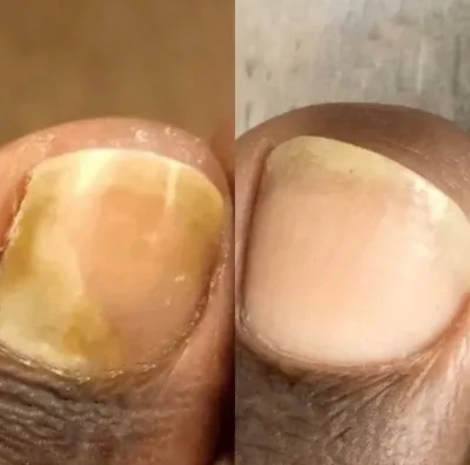 NagelVita Pro – Laser-Nagelpilz-Behandlungsgerät