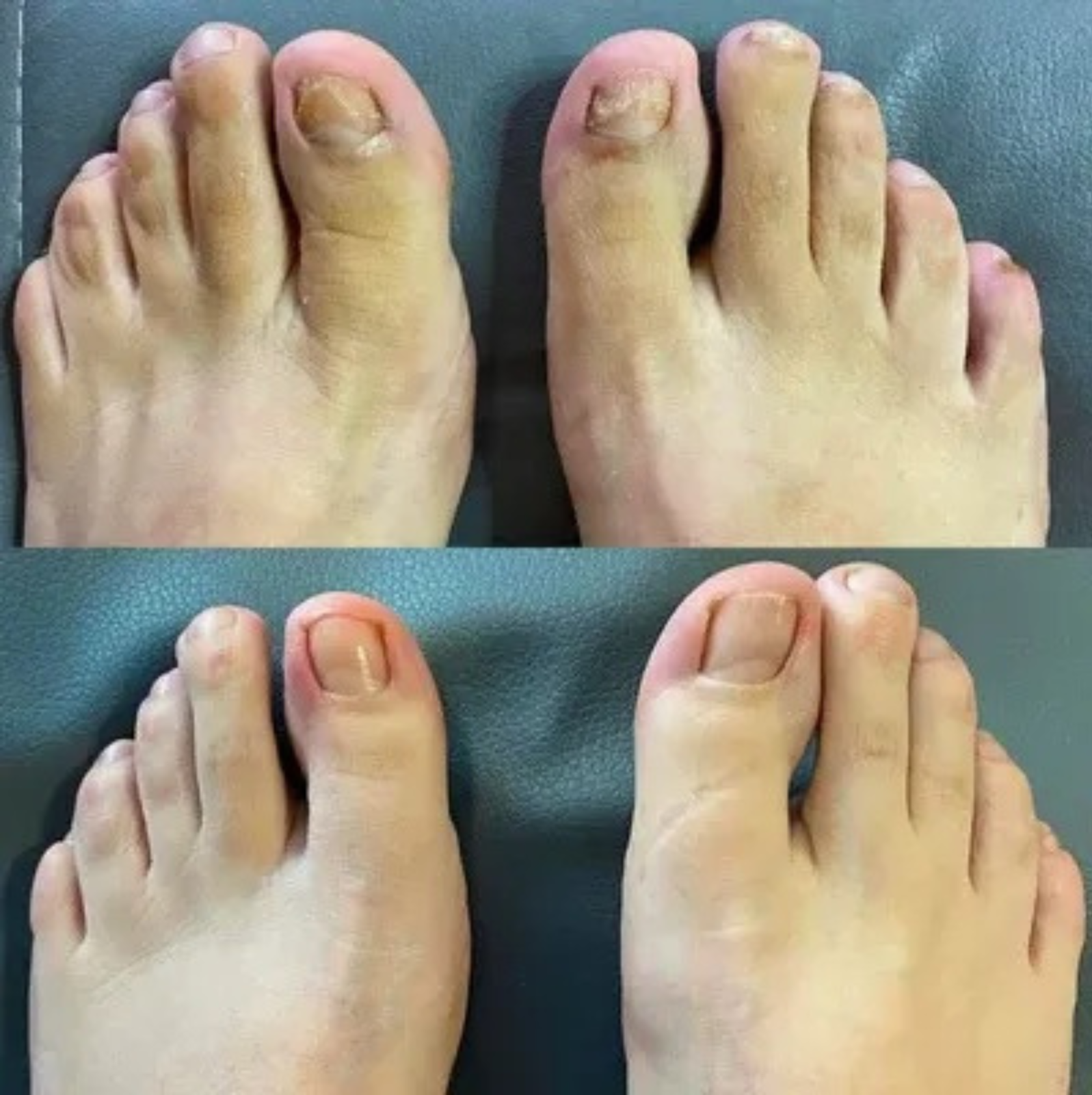 NagelVita Pro – Laser-Nagelpilz-Behandlungsgerät