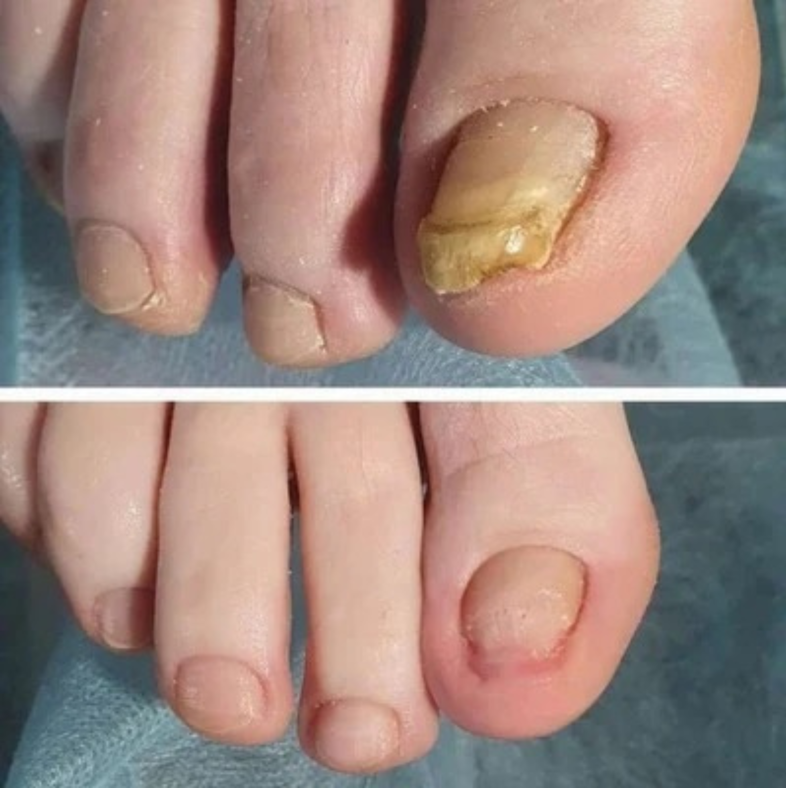 NagelVita Pro – Laser-Nagelpilz-Behandlungsgerät