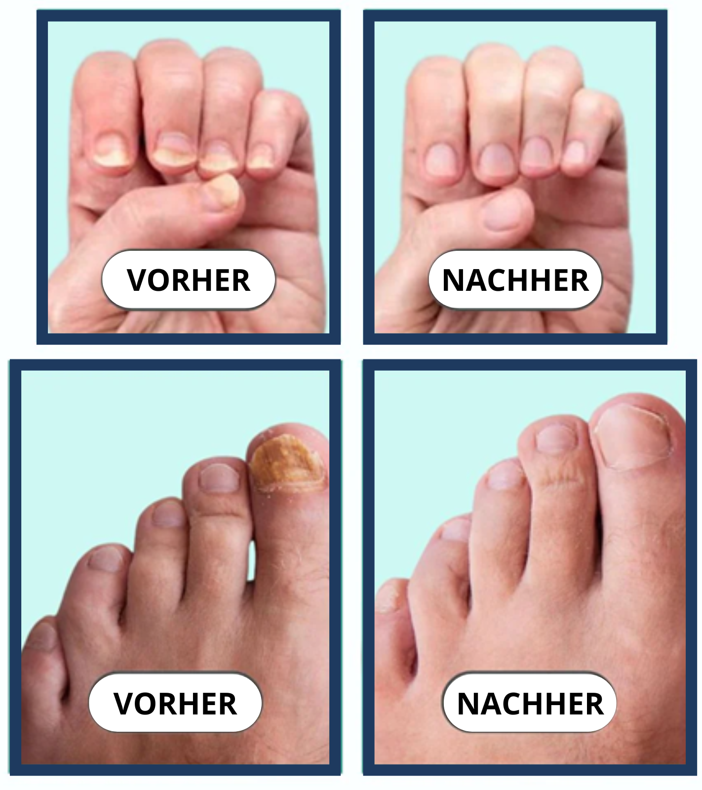 NagelVita Pro – Laser-Nagelpilz-Behandlungsgerät